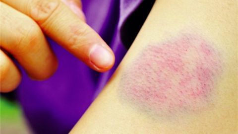 Các triệu chứng phụ thuộc một phần vào loại bệnh mà người bệnh đang mắc phải.