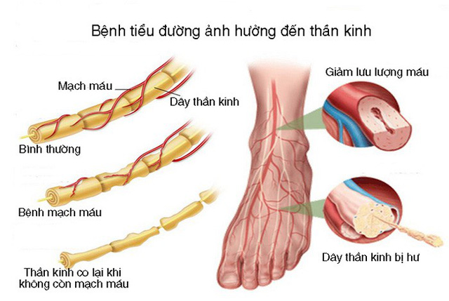 Khoảng 60 - 70% những người mắc bệnh tiểu đường bị bệnh thần kinh ngoại biên.