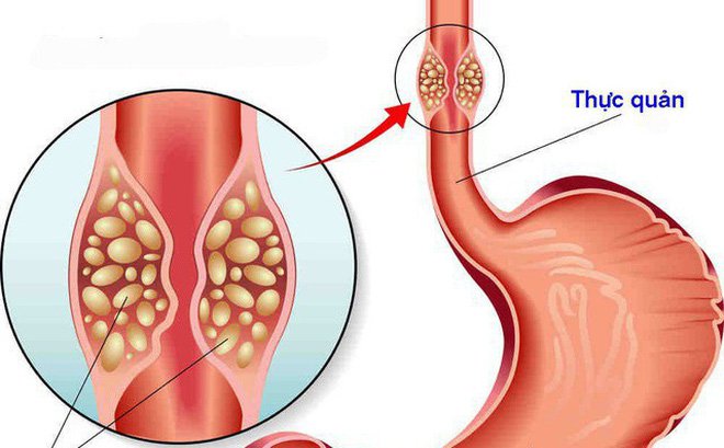 Khó nuốt là triệu chứng đầu tiên mọi người có thể nhận thấy. 