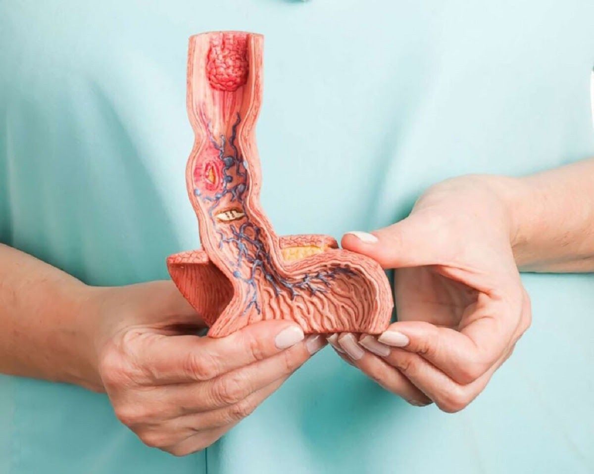Điều trị ung thư thực quản phụ thuộc vào giai đoạn và cấp độ ung thư. 