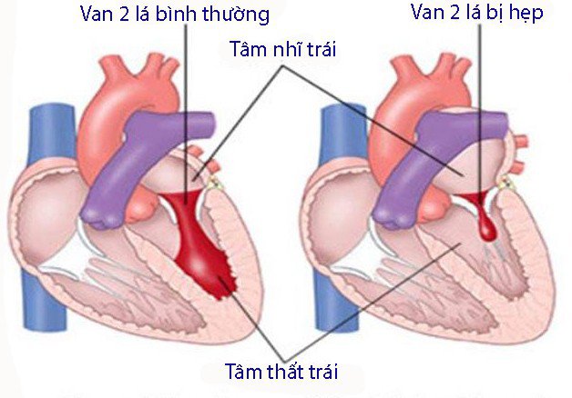 Bệnh van tim hậu thấp là bệnh xảy ra ở giai đoạn muộn của bệnh thấp tim.