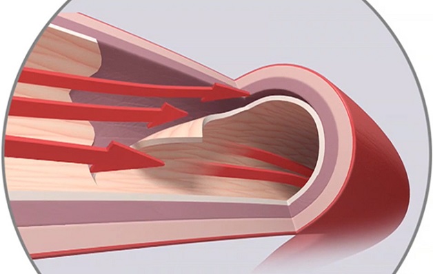 Bóc tách động mạch vành là gì và có phổ biến không?