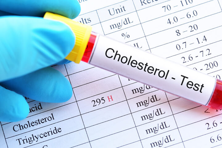 Cholesterol dư thừa có thể gây viêm trong động mạch