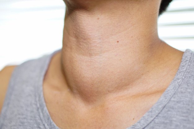 Hiểu về bệnh cường giáp để phòng ngừa nguy cơ đột quỵ