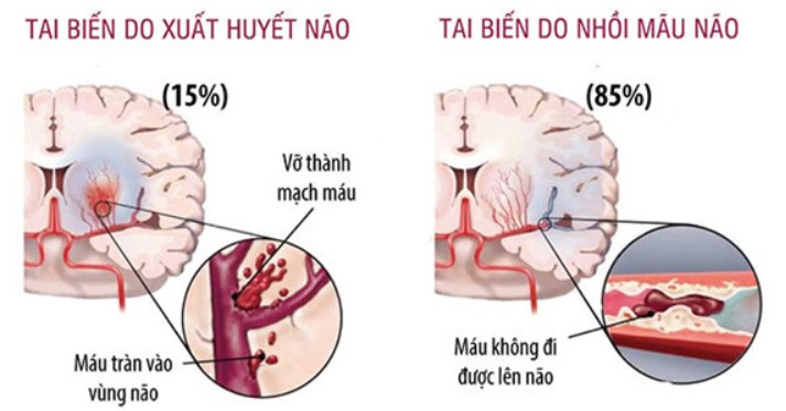 Đột quỵ xảy ra khi não không đủ ôxy khiến cho các tế bào não chết