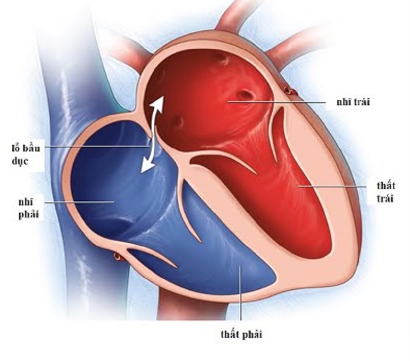 Tồn tại lỗ bầu dục (lỗ ovale - PFO) là lỗ trong tim không đóng đúng cách sau khi sinh. 