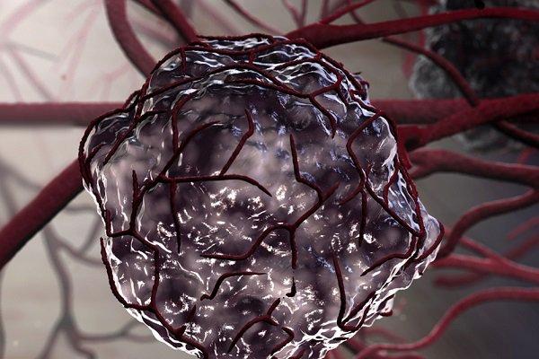 U ác tính phát triển khi các tế bào phát triển không kiểm soát được.