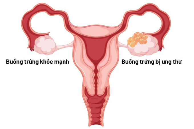 Điều trị tùy thuộc vào loại khối u và giai đoạn của bệnh.