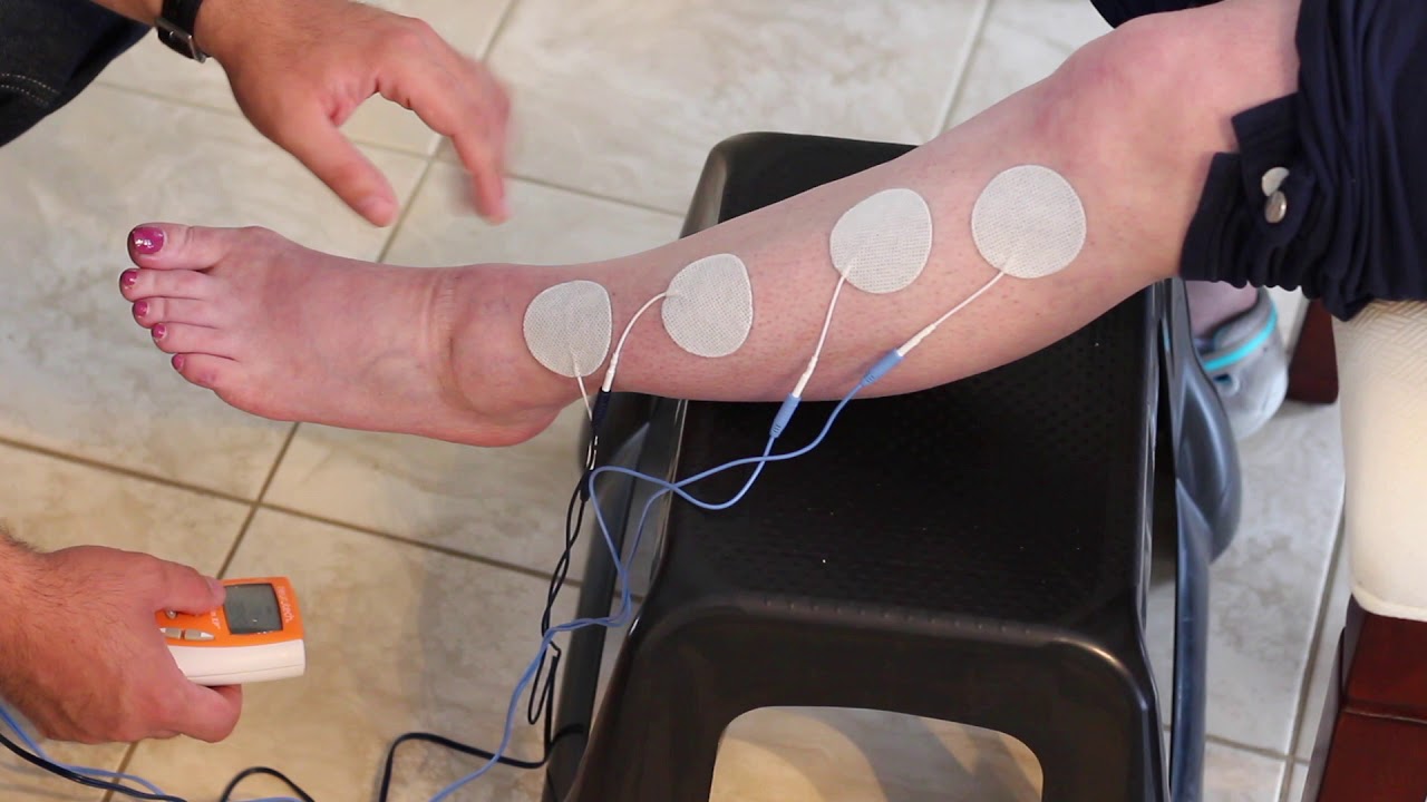 Nếu bệnh nhân đột quỵ bị liệt nửa người, kích thích điện sẽ giúp cải thiện và phục hồi nhanh chóng.