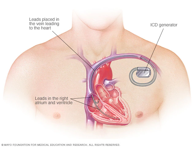 Máy khử rung tim cấy ghép giúp ngừa ngừng tim thế nào?