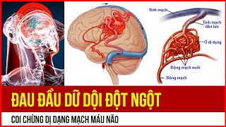 Đau đầu dữ dội và đột ngột có thể do dị dạng mạch máu não