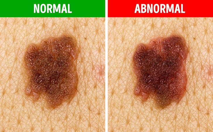 Nốt ruồi thay đổi hình dạng là một trong những triệu chứng của ung thư.