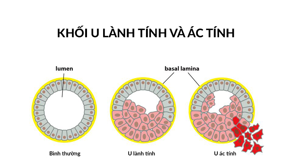 Phân u lành tính và u ác tính.