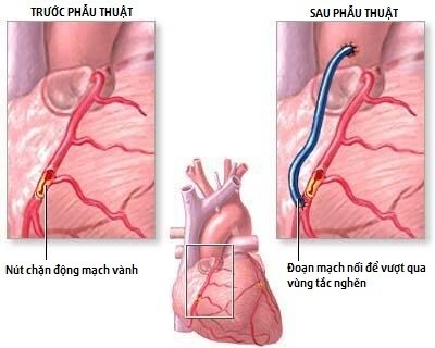 Phương pháp điều trị đột quỵ tim là gì?