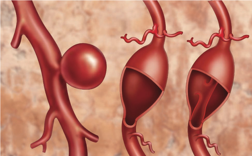 Chứng phình động mạch chủ: Nhận biết và điều trị