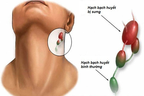 Các bệnh ung thư như ung thư hạch bạch huyết hoặc bệnh bạch cầu có thể làm cho các hạch bạch huyết sưng lên.