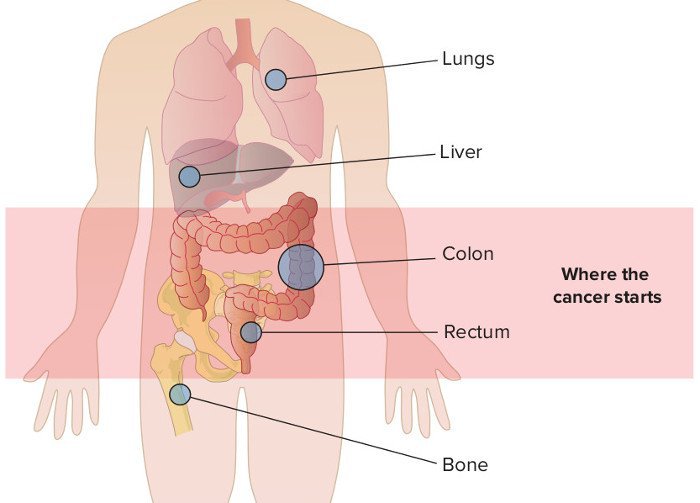 Di căn đề cập đến bệnh ung thư đã lan rộng ra khỏi điểm xuất phát đến các khu vực khác của cơ thể.
