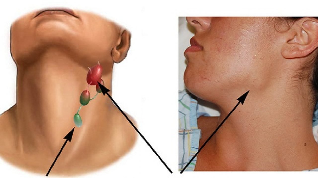 Có nhiều loại u lympho không Hodgkin khác nhau.