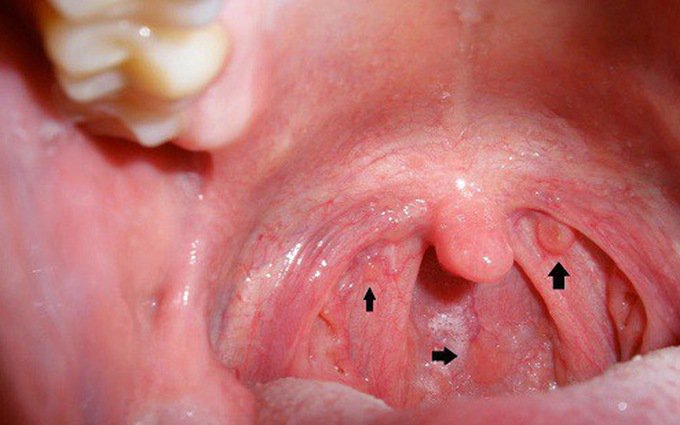 Bác sĩ sẽ hỏi bạn về các triệu chứng và bệnh sử để chẩn đoán ung thư thanh quản