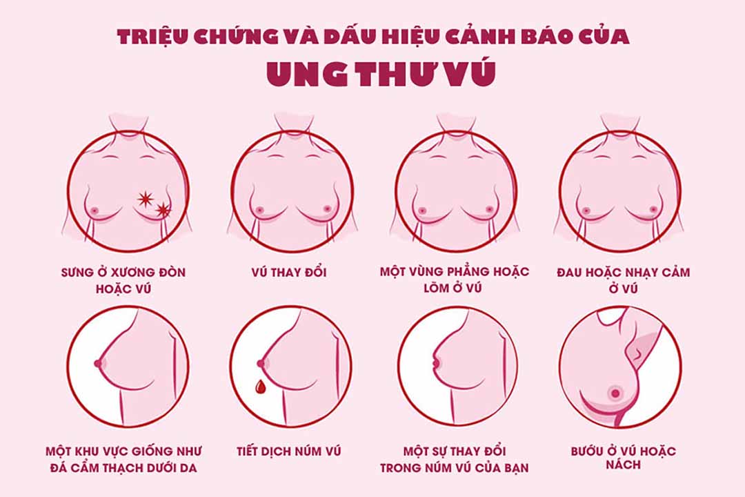 Triệu chứng của ung thư vú.