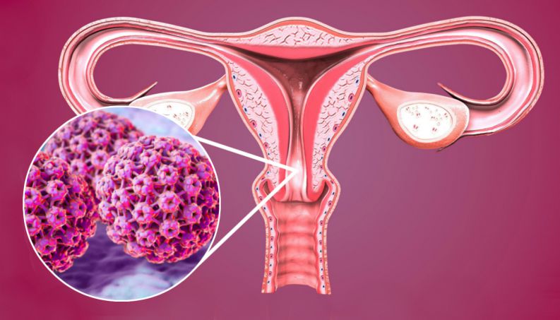 Sau khi bị nhiễm vi rút HPV thường mất nhiều năm để phát triển thành ung thư.