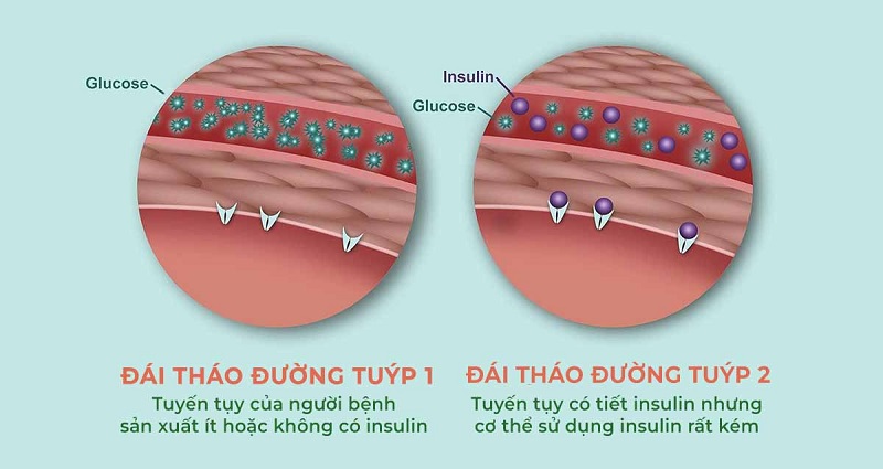 Ngày càng có sự gia tăng các chẩn đoán bệnh tiểu đường loại 2, ngay cả ở trẻ em