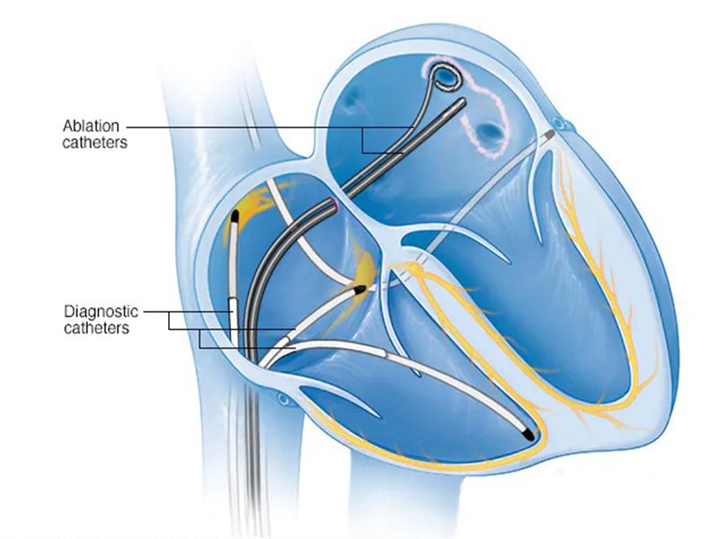 Biện pháp này phá hủy các mô khiến nhịp tim của bạn đi chệch hướng và tạo ra mô sẹo bên trong trái tim của bạn. 