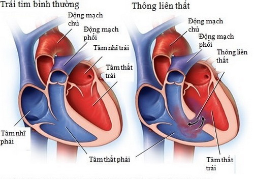 Lỗ thông trong tim