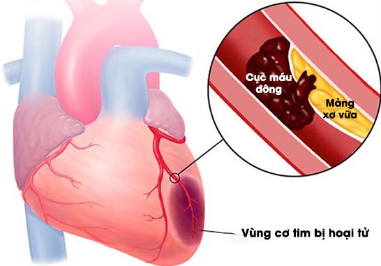 Nhồi máu cơ tim là gì?