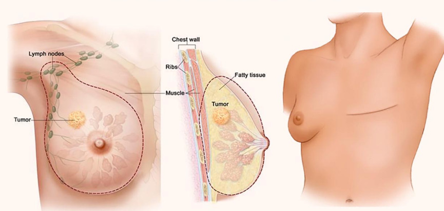 Những điều bạn cần biết về phẫu thuật ung thư vú