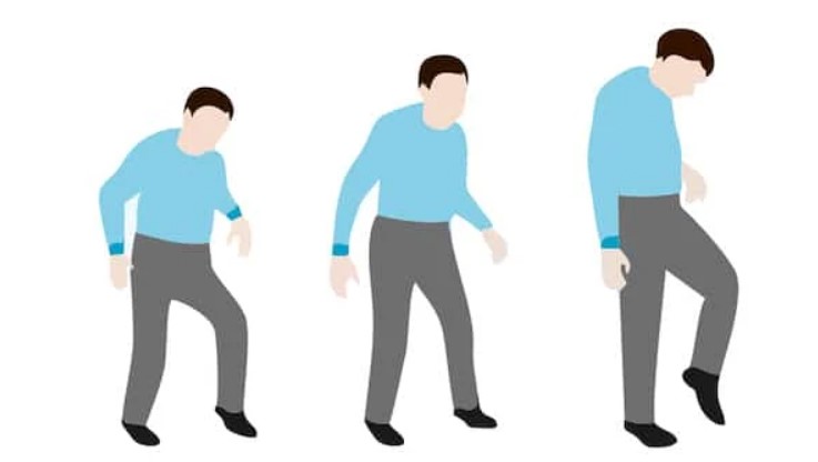 Rối loạn vận động sau đột quỵ là gì?