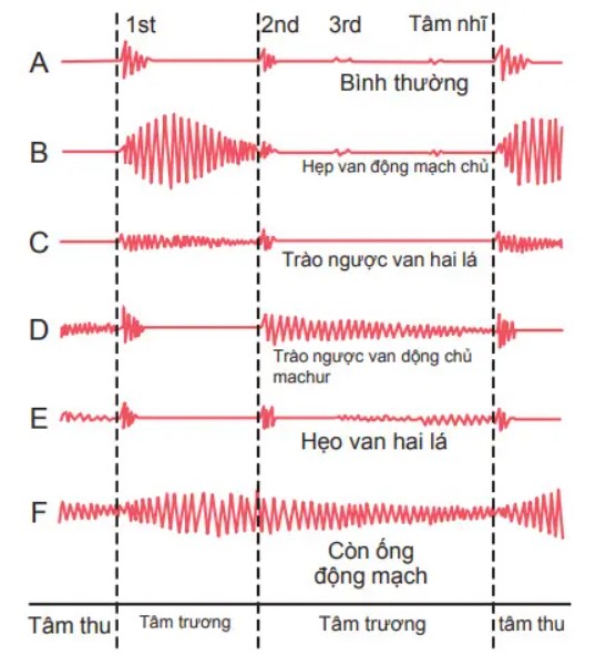 Máy ghi tiếng tim của tim bình thường và bắt thương