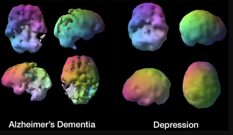 Bác sĩ X-quang hoặc bác sĩ chuyên khoa Chẩn đoán hình ảnh và Y học hạt nhân sẽ phân tích kết quả chụp SPECT của người bệnh. 