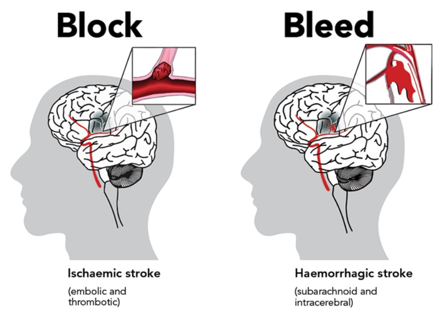 Đột quỵ có thể xảy ra do nhồi máu não và xuất huyết não