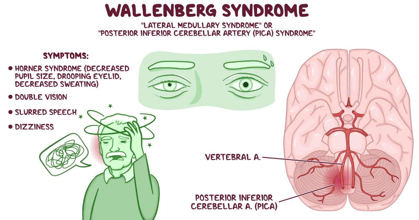 Hội chứng Wallenberg – hội chứng mạch máu ở thân não