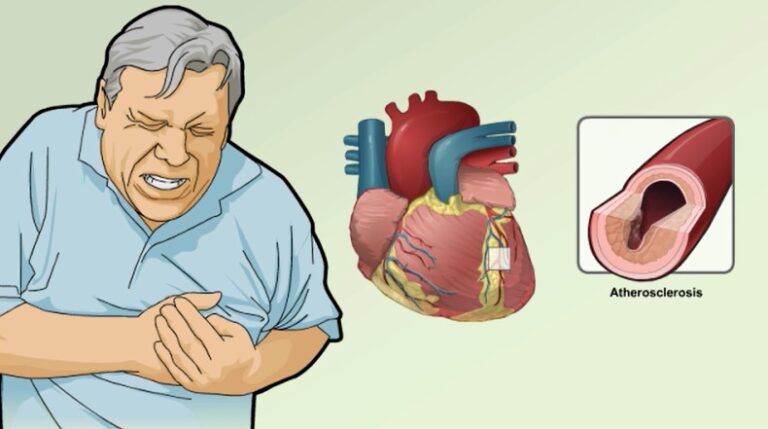 Dấu hiệu cảnh báo nhồi máu cơ tim cấp?