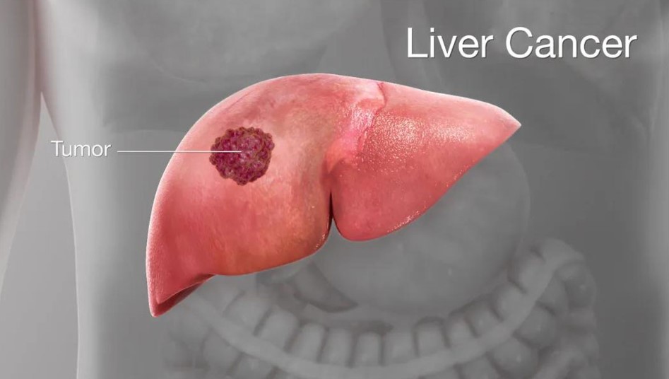 Ung thư gan nguyên phát hay còn gọi là ung thư biểu mô tế bào gan loại ung thư phổ biến trên thế giới và ở Việt Nam.