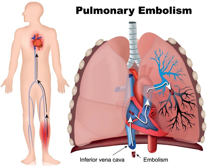 Thuyên tắc phổi xảy ra khi một cục máu đông - thường là từ chân (huyết khối tĩnh mạch sâu) vỡ ra, được đưa qua mạch máu và đọng lại trong các động mạch ở phổi. 