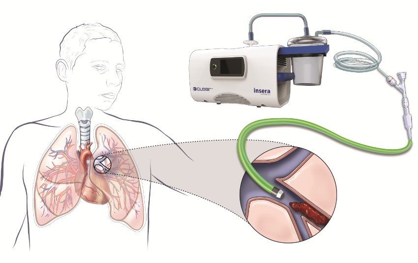 Bác sĩ có thể tiến hành can thiệp thủ thuật, hoặc phẫu thuật để lấy cục huyết khối ra