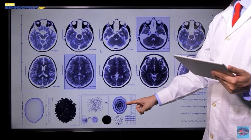 Suýt đột quỵ ở tuổi 30, người trẻ cần làm gì để phòng bệnh?