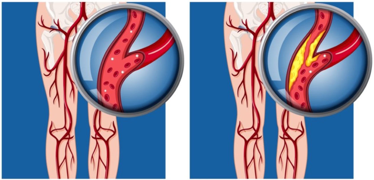 Thiếu máu cục bộ ở chi nguy kịch (CLI), điều trị thế nào?