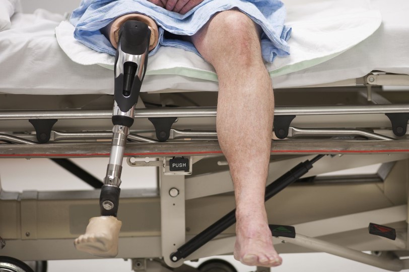 Thiếu máu cục bộ ở chi nguy kịch có thể dẫn đến cắt cụt chi