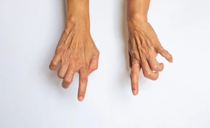 Tay chân bệnh nhân thường bị co cứng sau đột quỵ