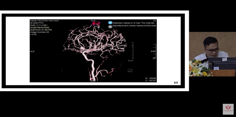 Điều trị phình mạch não đã vỡ bằng phương pháp thả coil