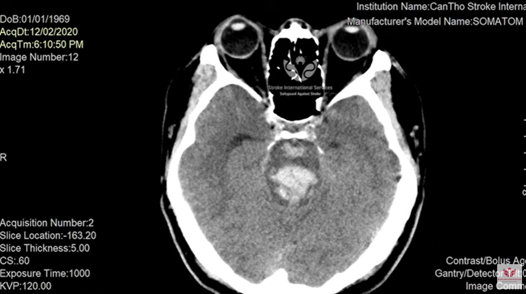 bệnh nhân đột quỵ