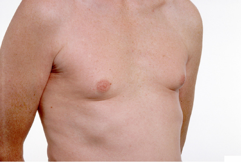 Điều trị ung thư vú ở nam giới tùy thuộc vào loại và giai đoạn của bệnh.