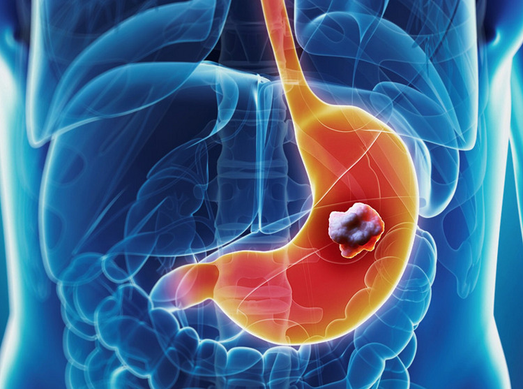 Các phương pháp điều trị bổ sung tấn công trực tiếp các tế bào ung thư.