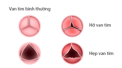 Nguyên nhân nào gây ra bệnh lý hở van tim?