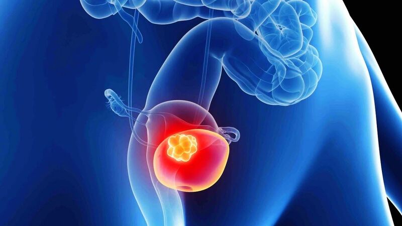 Các giai đoạn bao gồm từ TA (giới hạn trong niêm mạc bên trong bàng quang) đến IV (xâm lấn nhiều nhất).