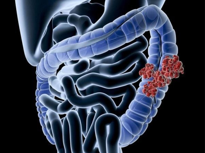 Ung thư biểu mô tuyến có thể lây lan sang các bộ phận khác của cơ thể.